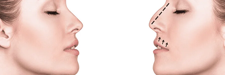 Rinoplasti- Nose Job-Nasenkorrektur-Rinoplastia-Rhinoplastie-Ринопластика-Ринопластика-Rinoplasti
