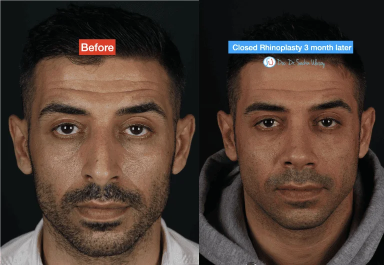 Rhinoplastik Vorher nachher 
