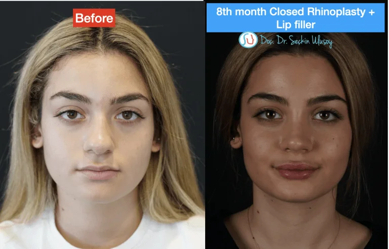 Nose operation long-term results 