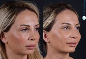 Revision Rhinoplasty results by Dr. Seckin Ulusoy