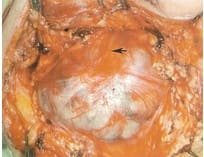 Ok işaretiyle parotis tümörü görülmektedir