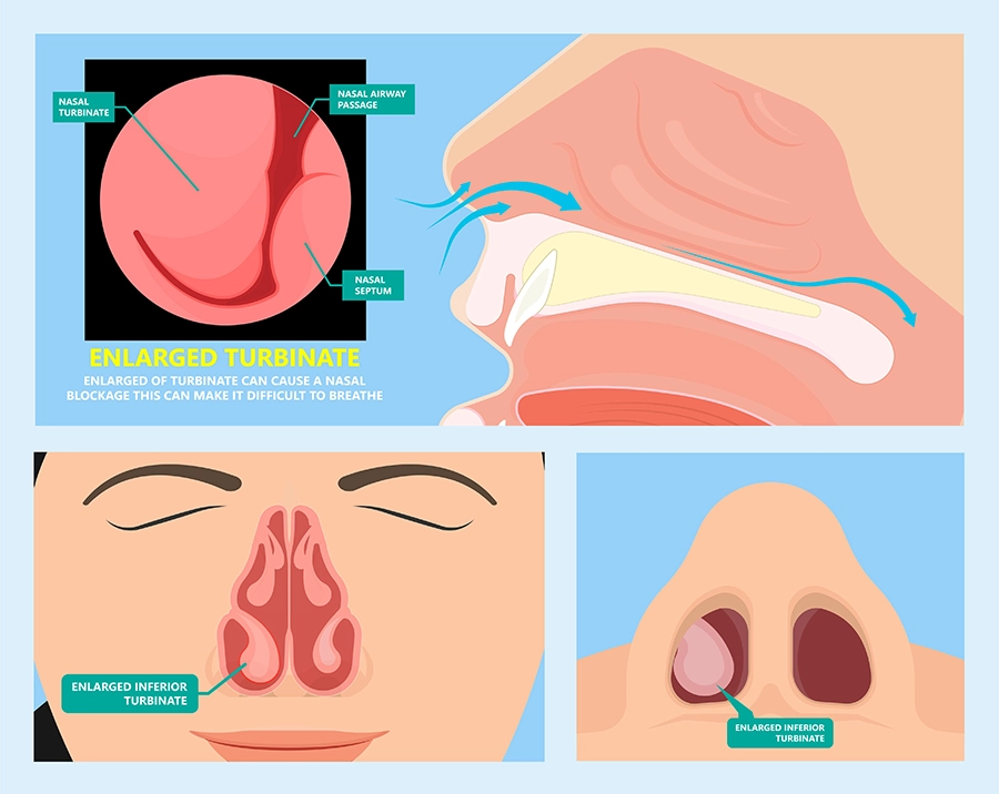 Nose Job has two aims: Nose Functions and Aesthetics