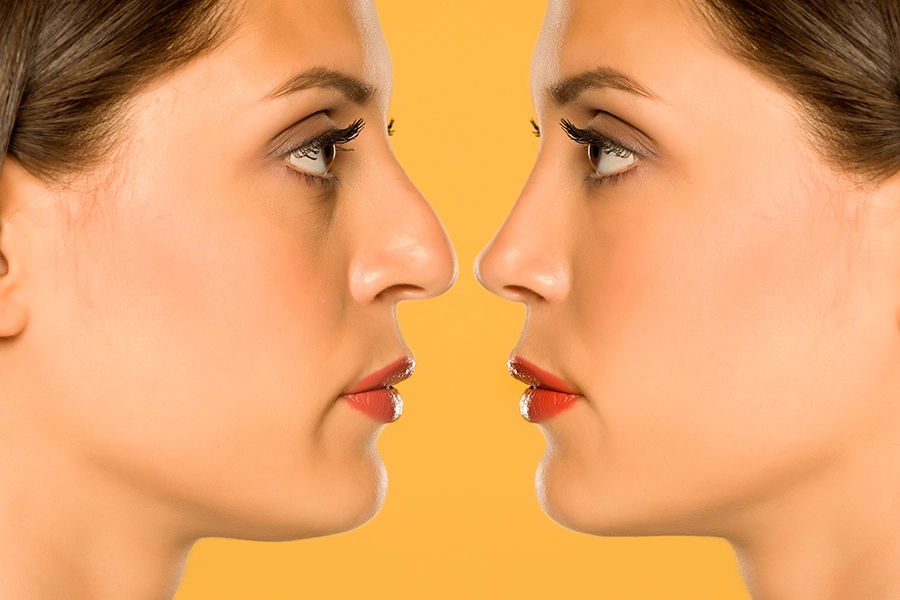 Nasal tip plasty and a nose job can be performed in the same session.