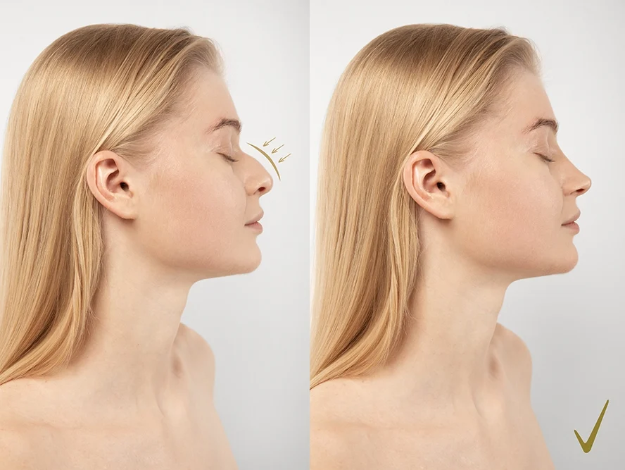 Nose Job in İstanbul/ Turkey