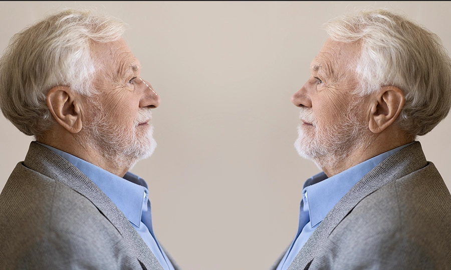 Up to 5th Decade Rhinoplasty