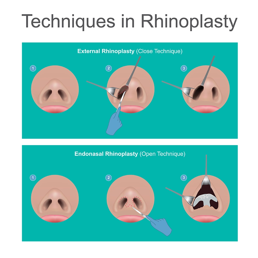 Nose Job: Open and Closed Surgery Techniques