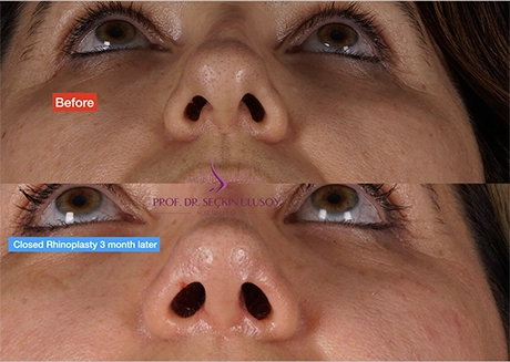 Closed Nose Job Before and After