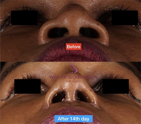 Closed Ethnic Rhinoplasty Before and After