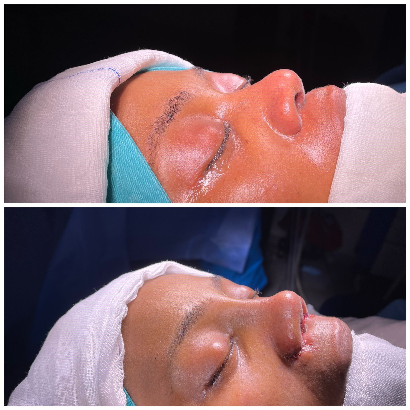 Revision African American Nose Job + Alar Base Reduction 