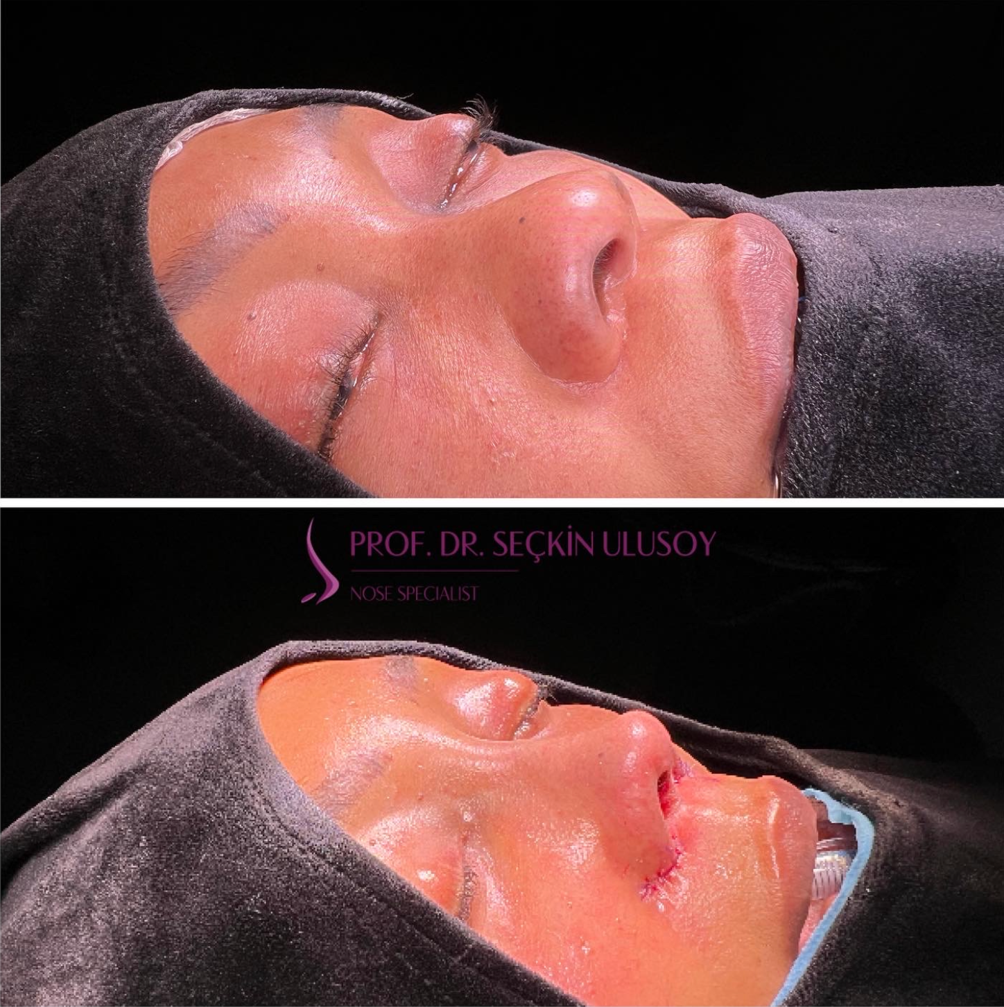 Ethnic nose job with Alar base reduction surgery