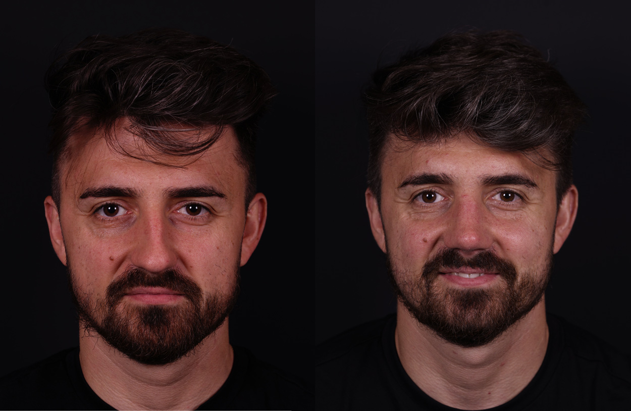 Closed nose job before and 4th month after 