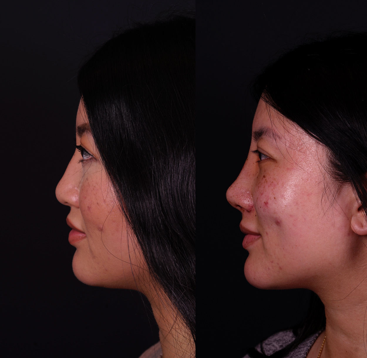 Closed Asian Nose Job 5th day Before and After 