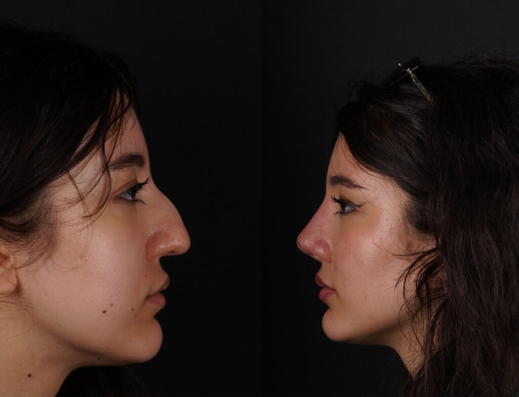 Los resultados finales de la rinoplastia de revisión se producen al cabo de 8-12 meses.