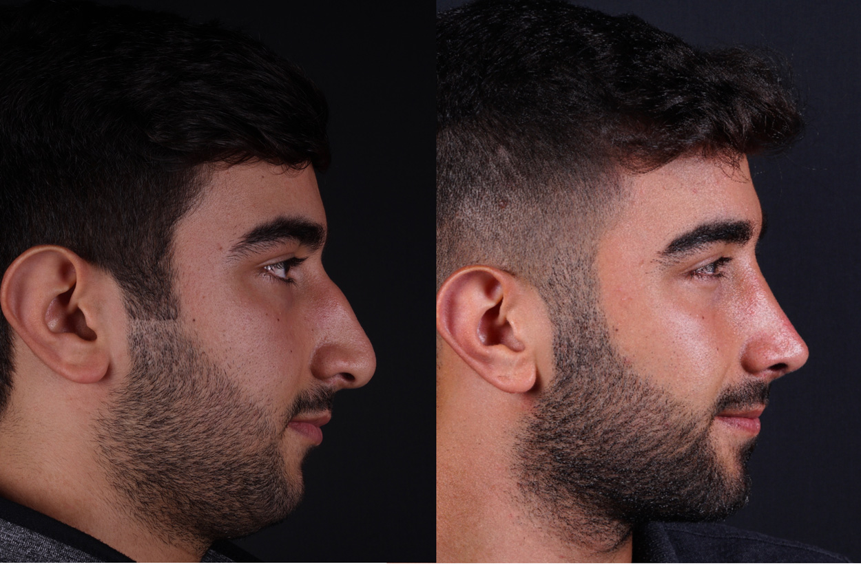 Closed nose job before and 8th month after 