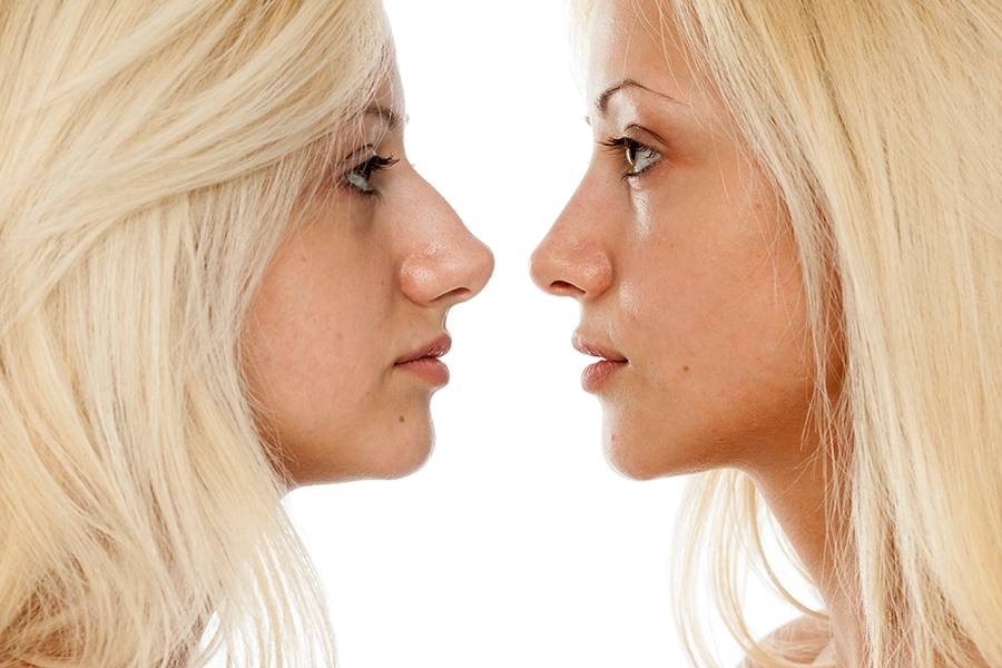 The best nose job surgeon can give you the dream nose.
