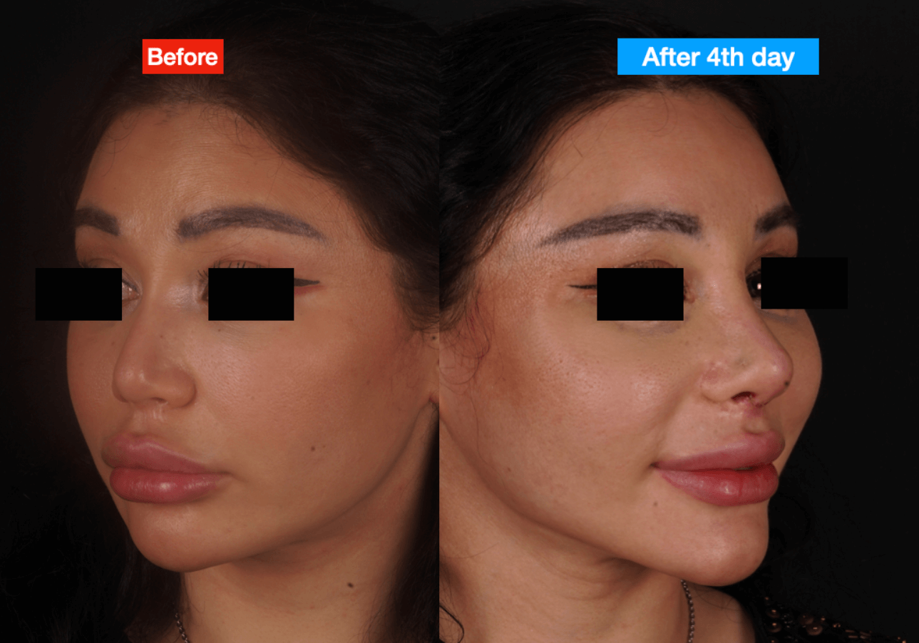 Early Results of Revision Asian Nose Job
