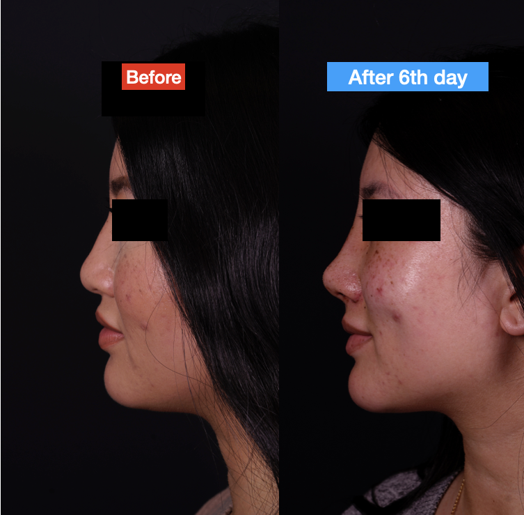 Asian Nose Job