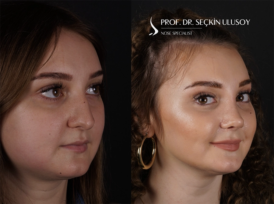 Rhinoplastik Vorher Nasenkorrektur