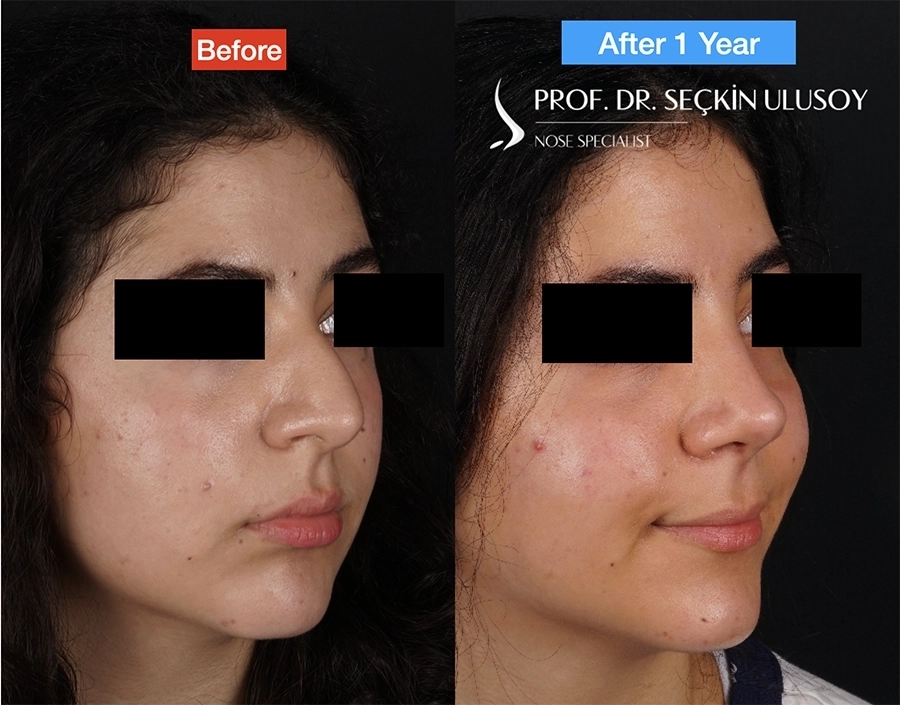 Ultrasonik Piezo Rinoplasti Öncesi ve Sonrası Sonuçları 