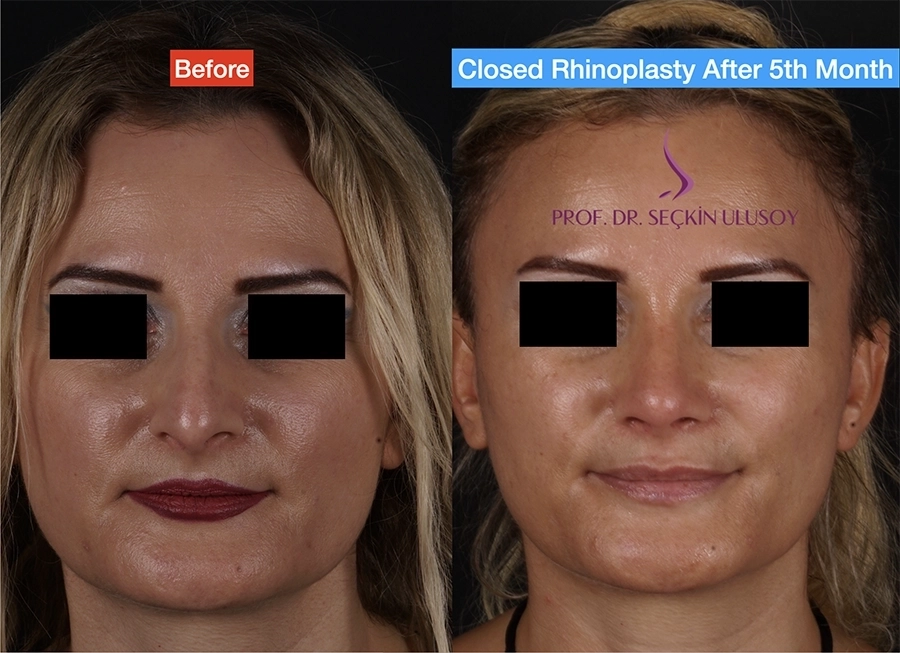 Ultrasonik Piezo Burun Estetiği Öncesi ve Sonrası Sonuçları (Geç Dönem)