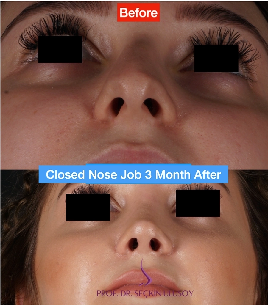 Ultrasonik Piezo Rinoplasti Öncesi ve Sonrası Sonuçları 