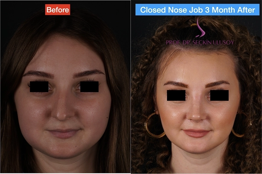 Ultrasonik Piezo Rinoplasti Eğri Burun Öncesi ve Sonrası 