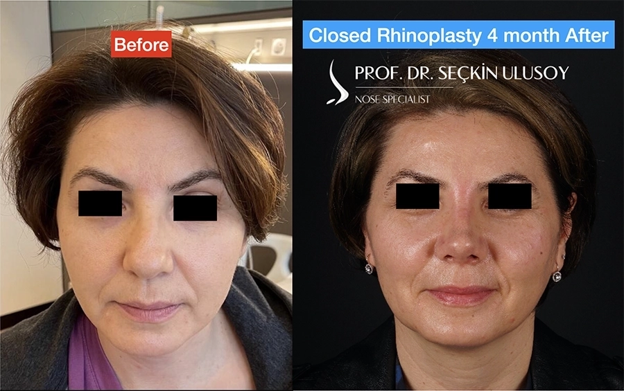 Ultrasonik Piezo Rinoplasti Kalın Derili Hasta Öncesi ve Sonrası 