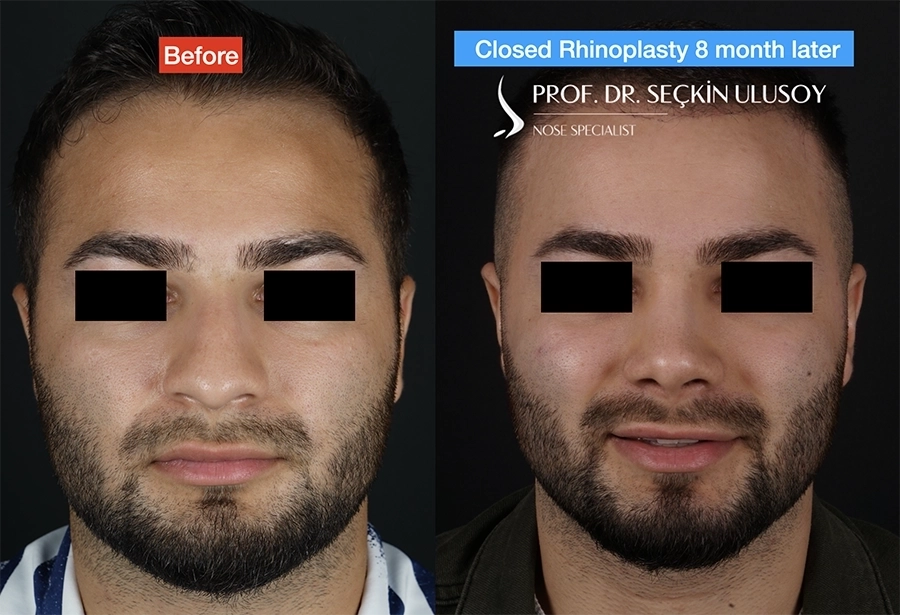 Ultrasonik Piezo Rinoplasti Öncesi ve Sonrası Sonuçları 
