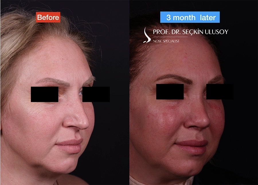 Ultrasonik Piezo Rinoplasti Öncesi ve Sonrası Sonuçları 