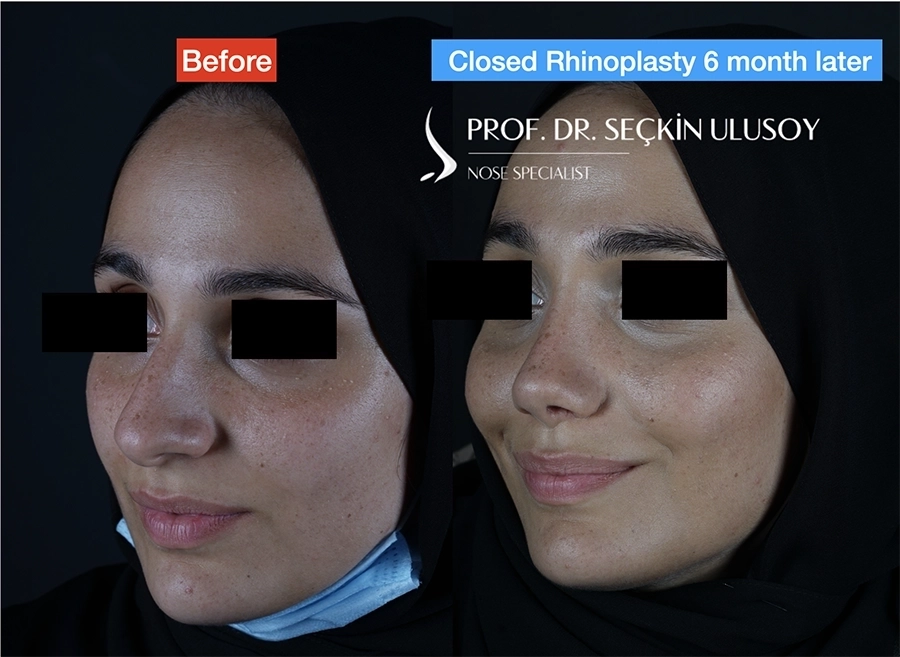 Ultrasonik Piezo Rinoplasti Öncesi ve Sonrası