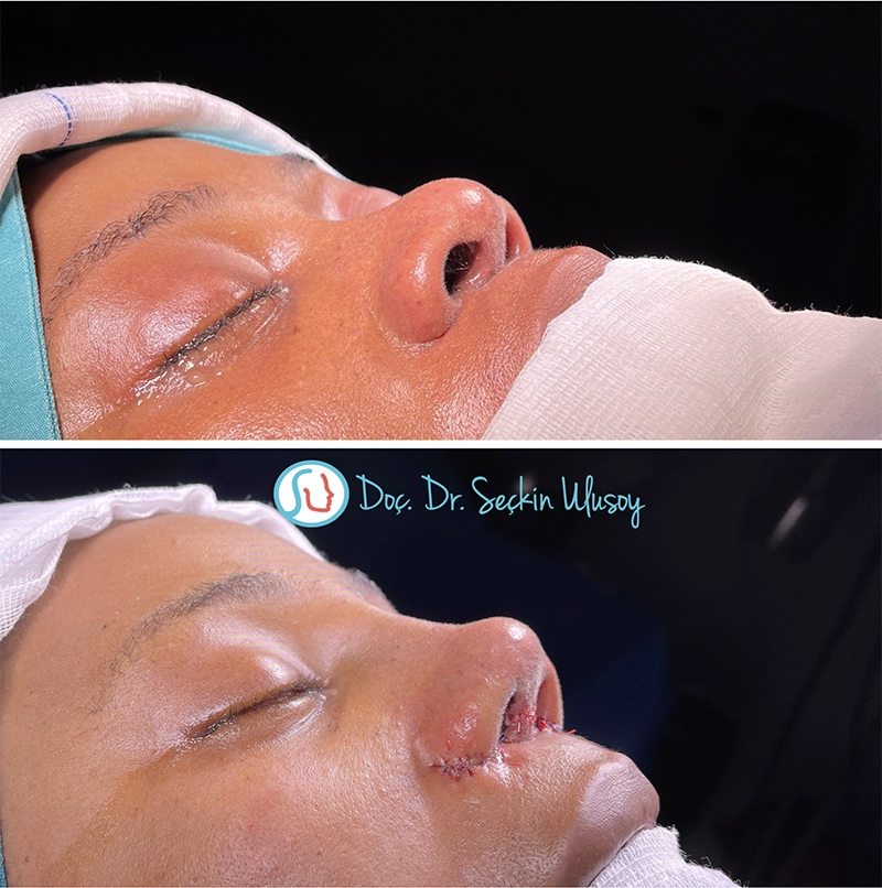 Alar base reduction at the Ethnic nose job