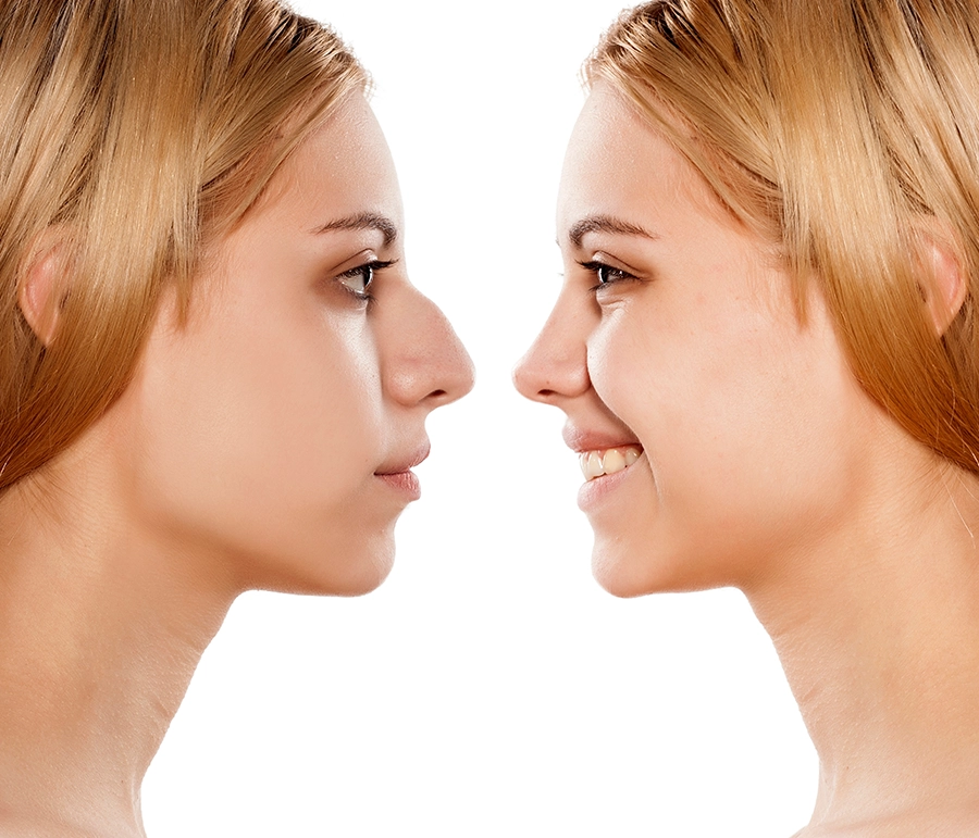 Closed Nose Surgery Picture Simulations Before and After