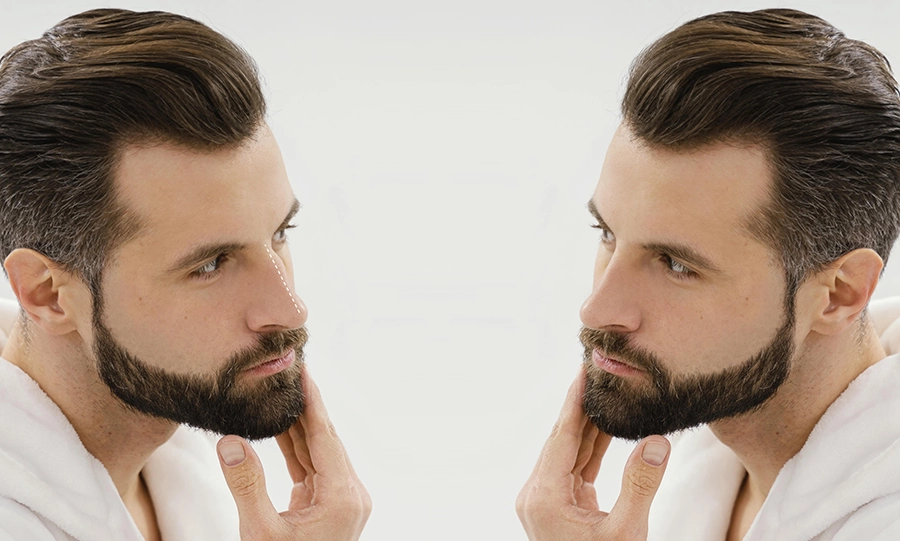 Revision Rhinoplasty in İstanbul / Turkey