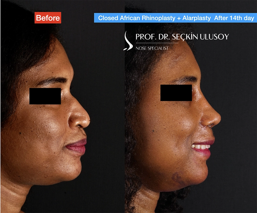 Rhinoplastie africaine avant et après