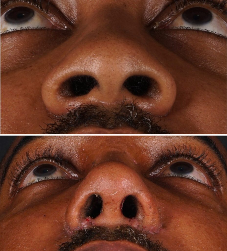 Rhinoplastie africaine Technique fermée Plastie de la base alaire et chirurgie de réduction des narines