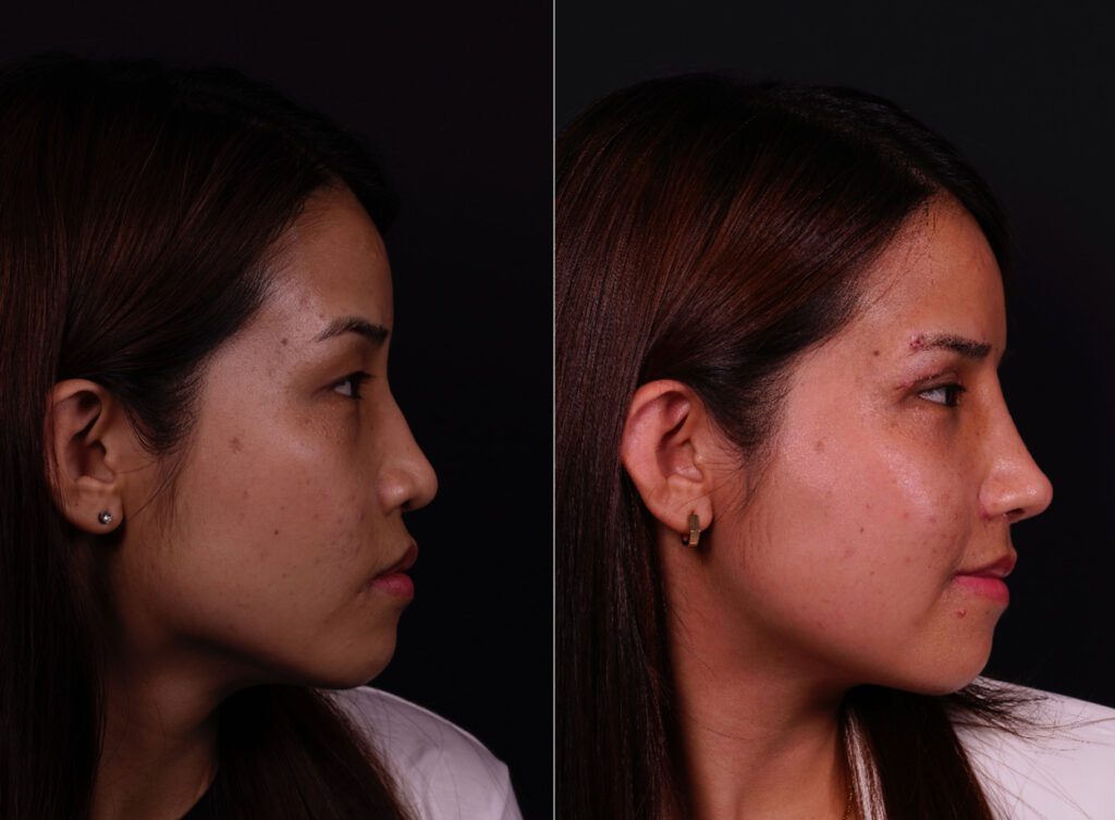 Rhinoplastie asiatique avant et après
