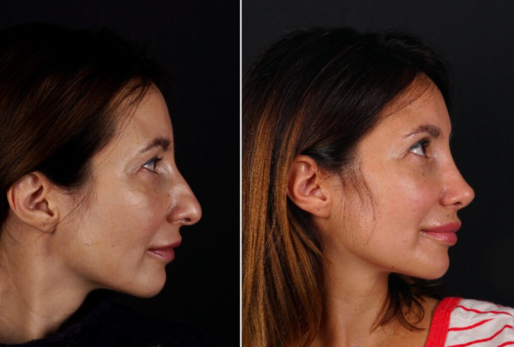Résultats avant et après la rhinoplastie