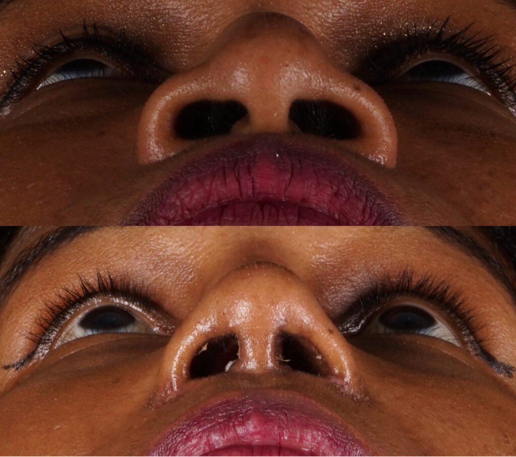 Rhinoplastie afro-américaine fermée 2 semaines plus tard