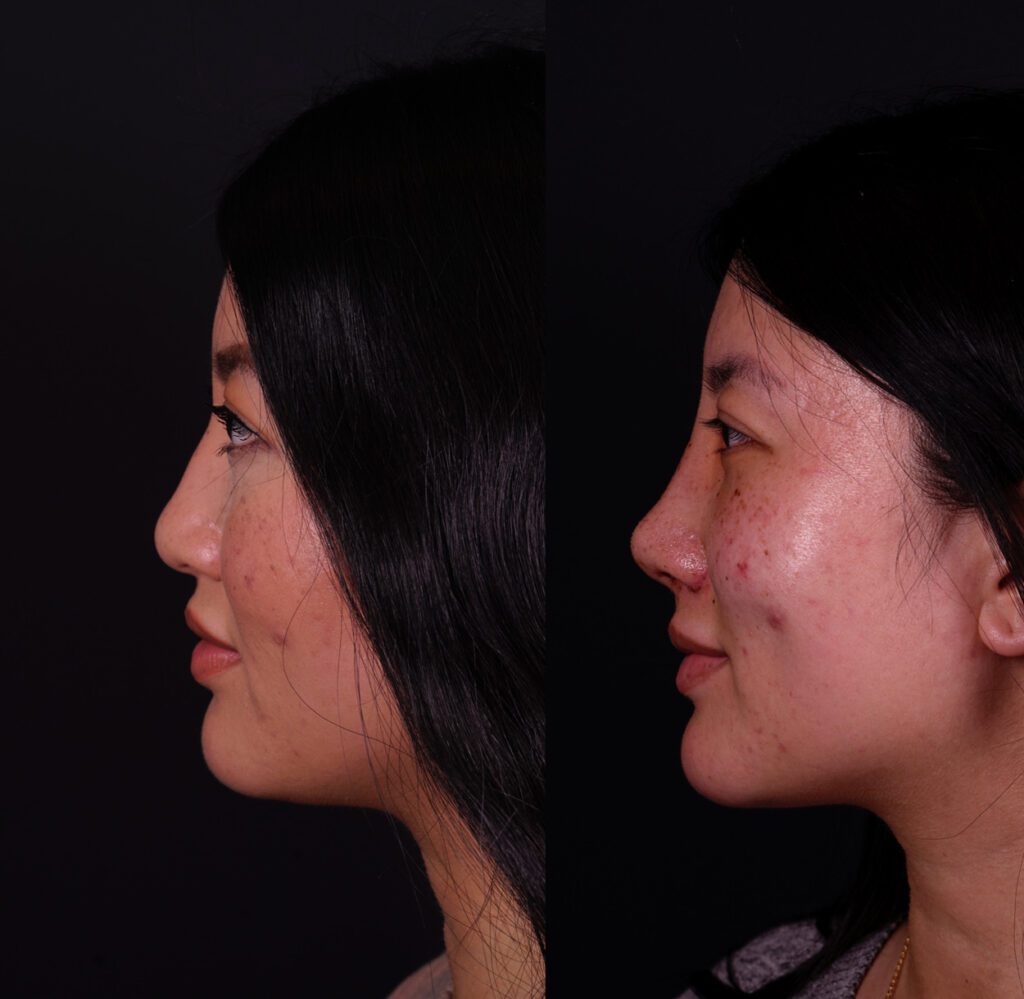 Rhinoplastie asiatique fermée 5e jour avant et après