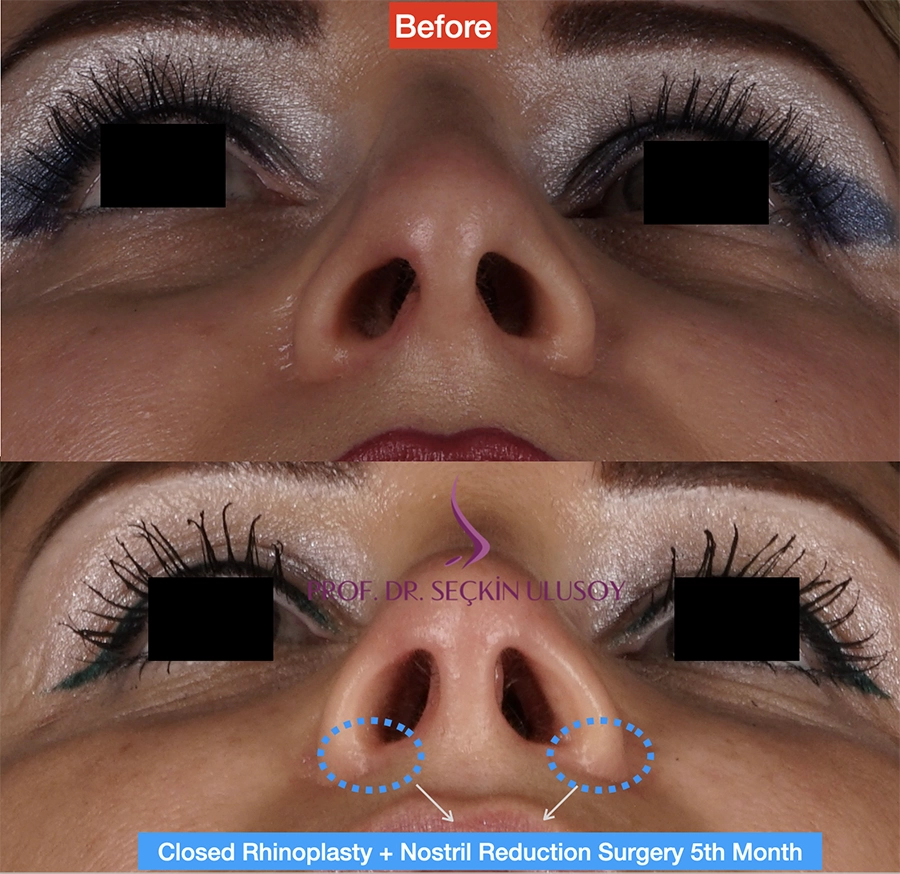 Rhinoplastie fermée + alarplastie avant et après