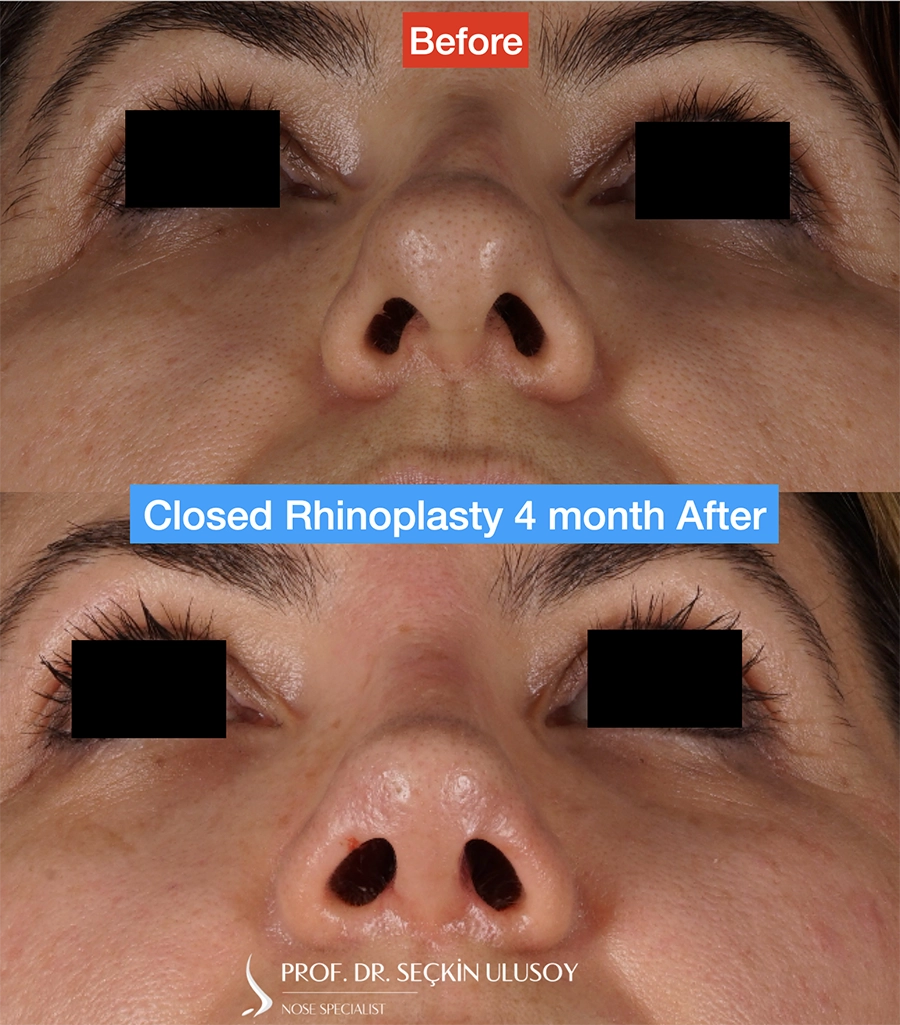 Rhinoplastie fermée avant et après