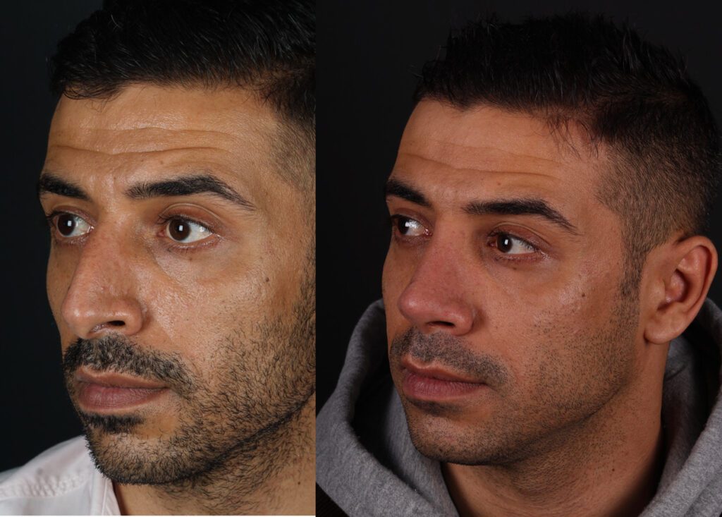 Rhinoplastie masculine fermée 6e mois avant et après