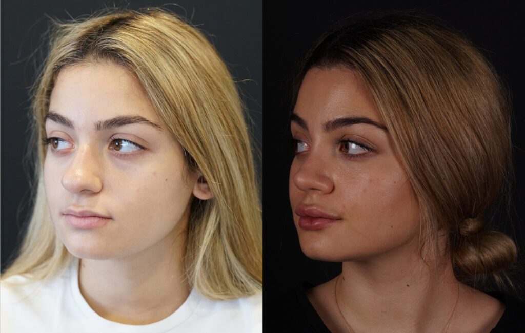 Rhinoplastie fermée avant et 6e mois après