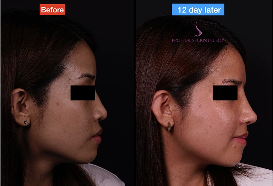 Rhinoplastie ethnique avant et après 12 jours plus tard