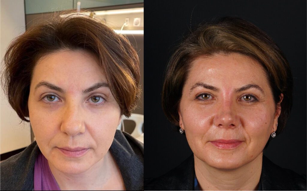 Rhinoplastie avant et après FEMME DE 50 ANS