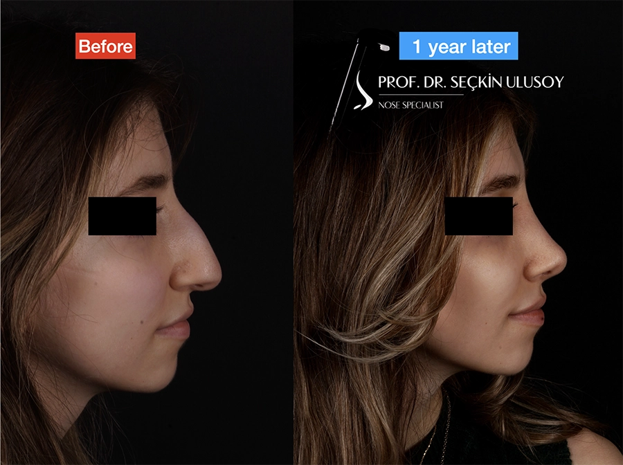 Rhinoplastie avant et après résultat à 1 an