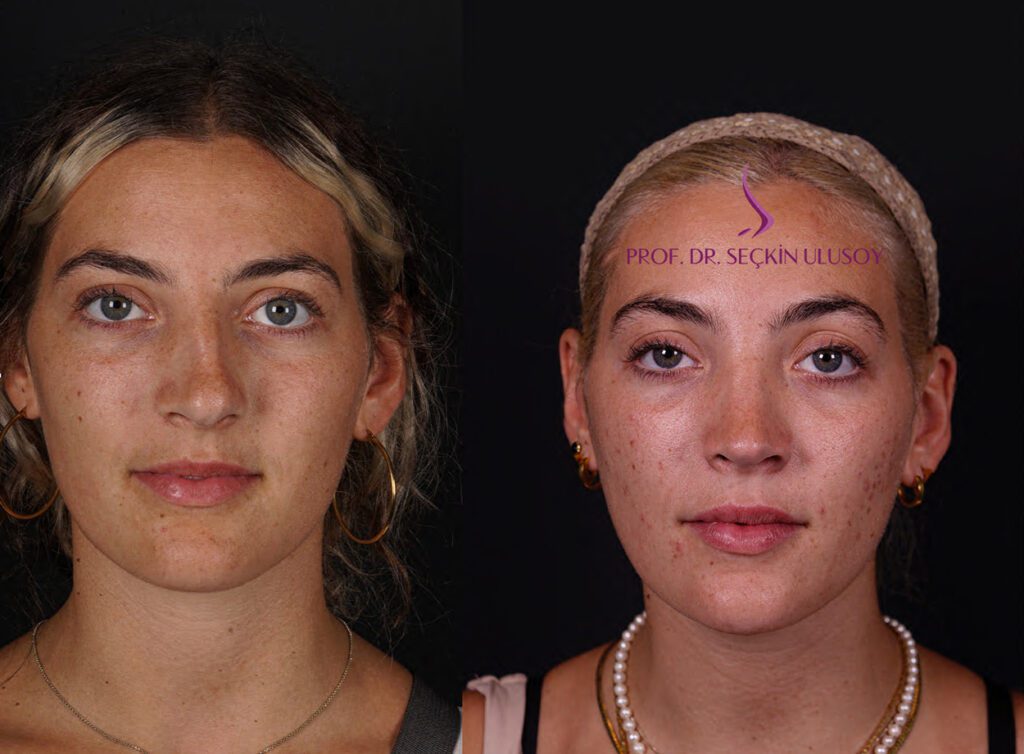rinoplastia nariz bulbosa antes y despues