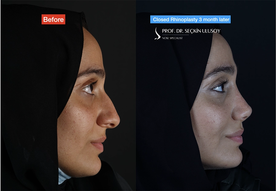 Closed Nose Job Before and After