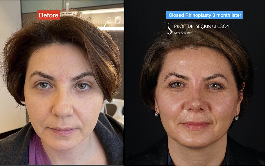 Closed Nose Surgery Before and After