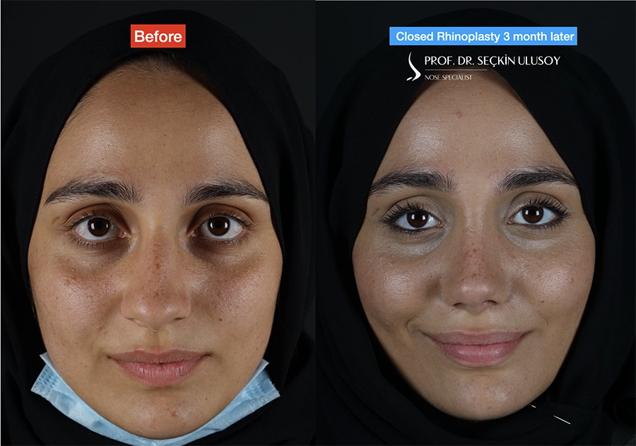 Closed Nose Job Before and After